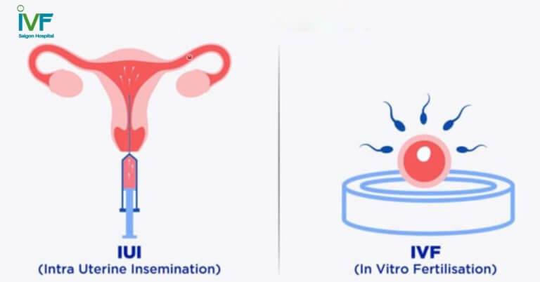 Sự khác biệt giữa phương pháp IVF và IUI?