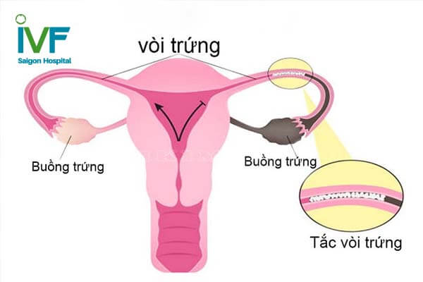 tắc vòi trứng