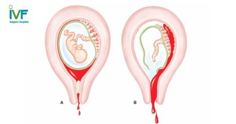 Vỡ tử cung trong thai kỳ: Những điều sản phụ nên lưu ý