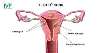 U xơ tử cung: Những trường hợp chỉ định phẫu thuật 