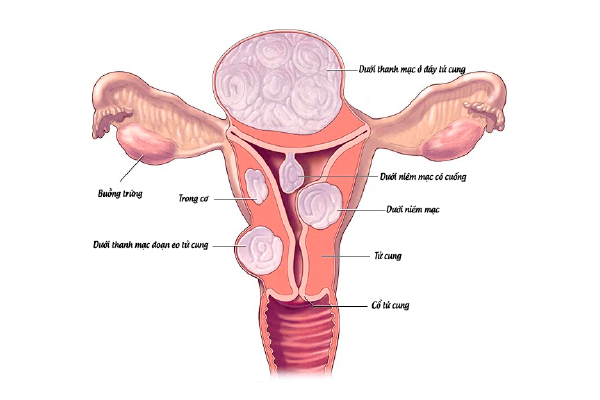 nhân xơ tử cung