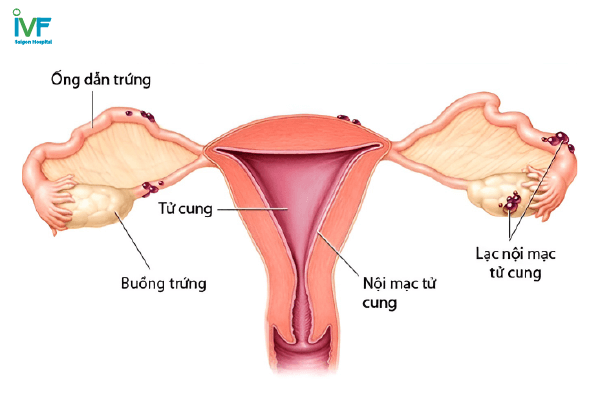 Lạc nội mạc tử cung