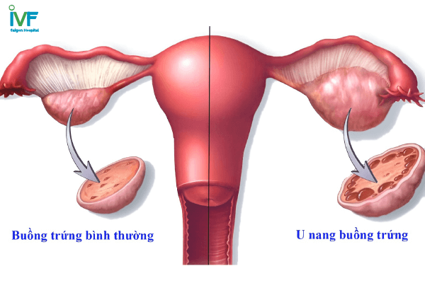 u nang buồng trứng