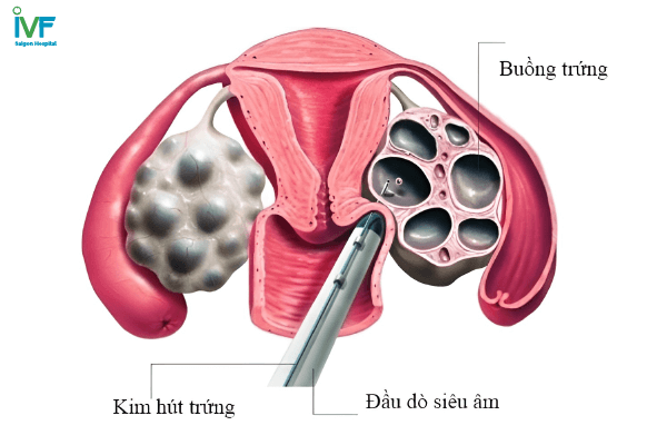 quá trình chọc hút trứng