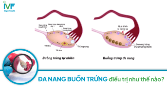 ĐA NANG BUỒNG TRỨNG: Dấu hiệu và nguyên nhân nhận biết thế nào?