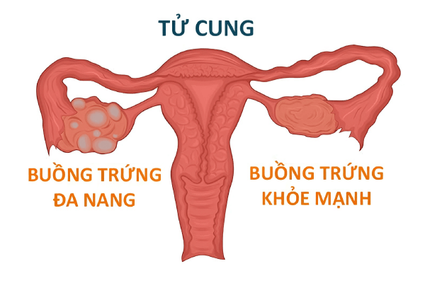 đa nang buồng trứng