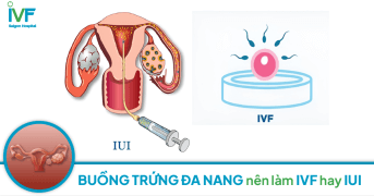 HỘI CHỨNG  BUỒNG TRỨNG ĐA NANG ở nữ giới nên làm IVF hay IUI?