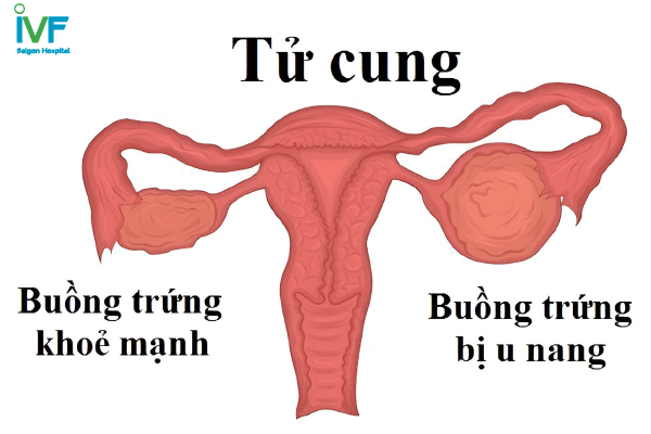 nang đơn thùy buồng trứng