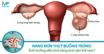 Nang đơn thùy buồng trứng: Ảnh hưởng đến khả năng sinh sản thế nào?