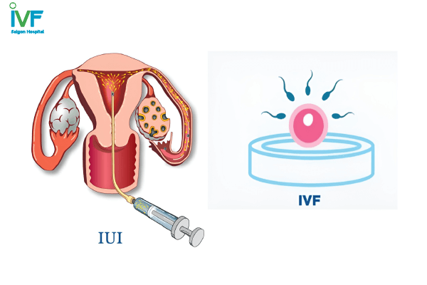 Hội chứng buồng trứng đa nang