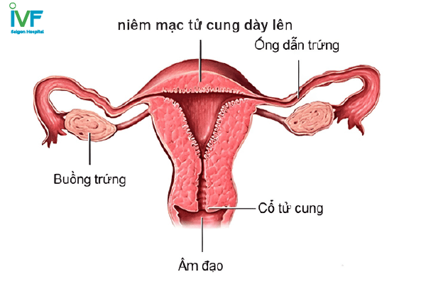 niêm mạc tử cung