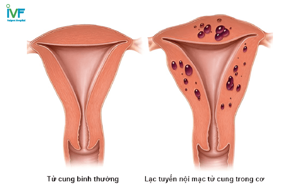 Lạc nội mạc tử cung