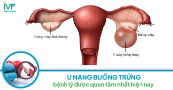 U NANG BUỒNG TRỨNG: Bệnh lý được quan tâm nhiều nhất hiện nay