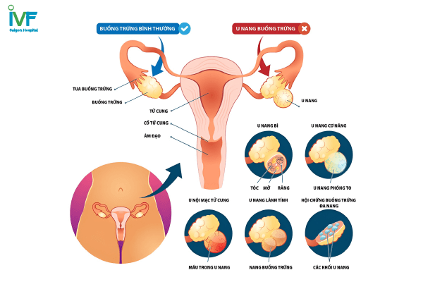 u nang buồng trứng