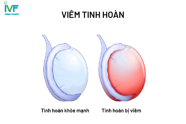 viêm tinh hoàn do quai bị 