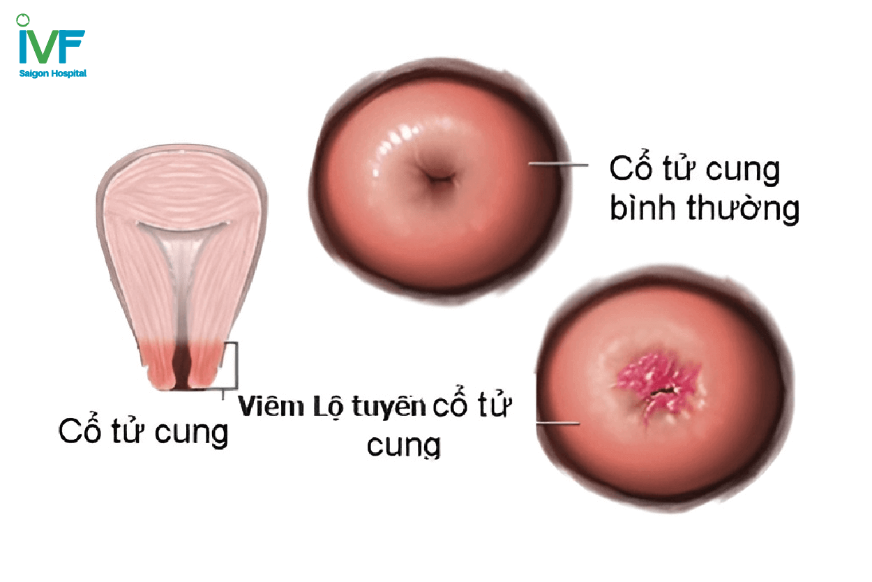 Viêm lộ tuyến cổ tử cung