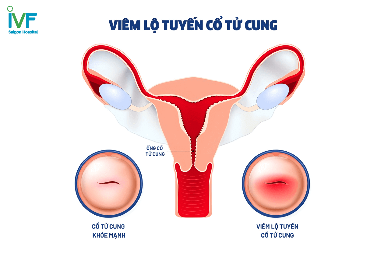 Viêm lộ tuyến cổ tử cung