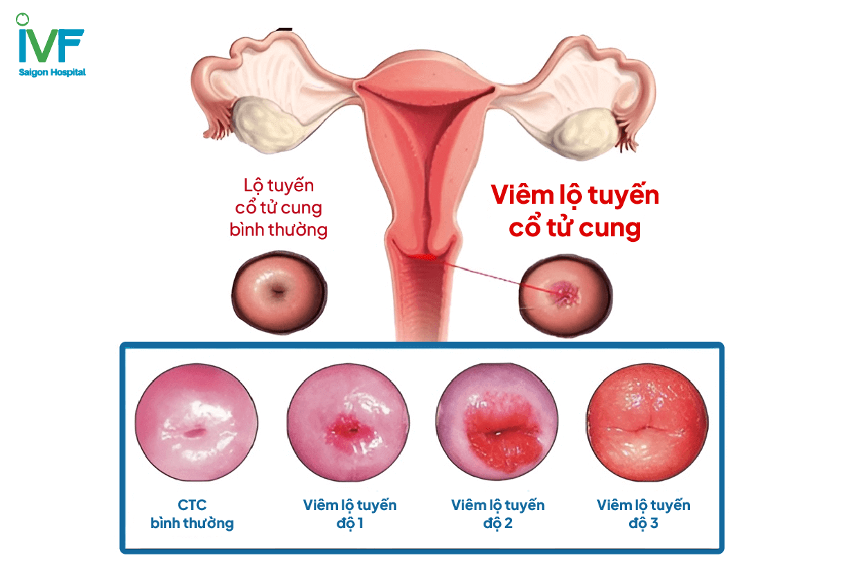 Viêm lộ tuyến cổ tử cung