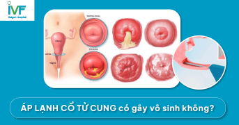 Áp Lạnh Cổ Tử Cung Có Gây Vô Sinh không?