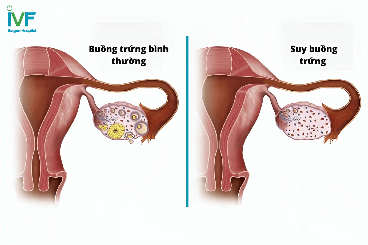 suy buồng trứng sớm