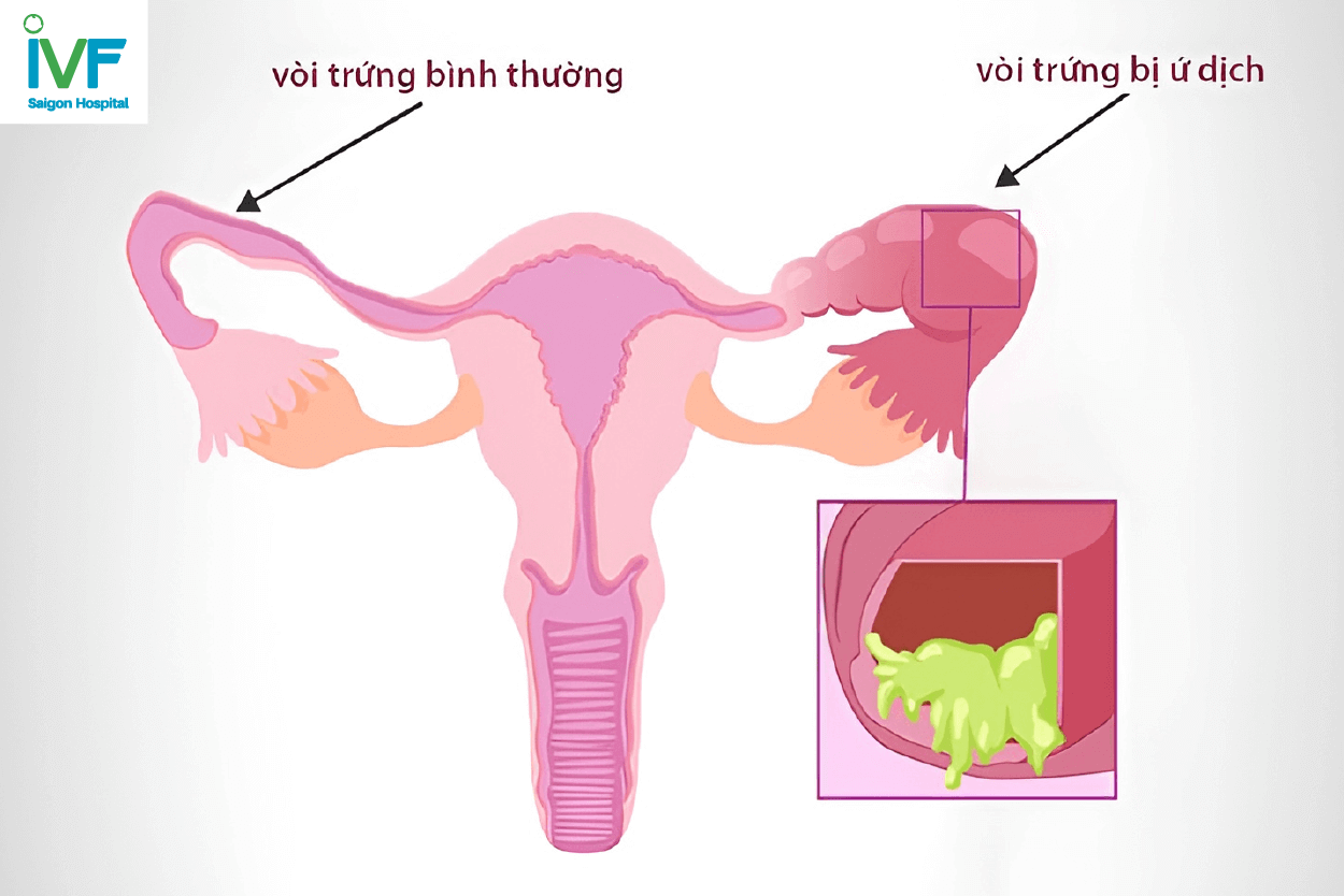 tắc ứ dịch ống dẫn trứng