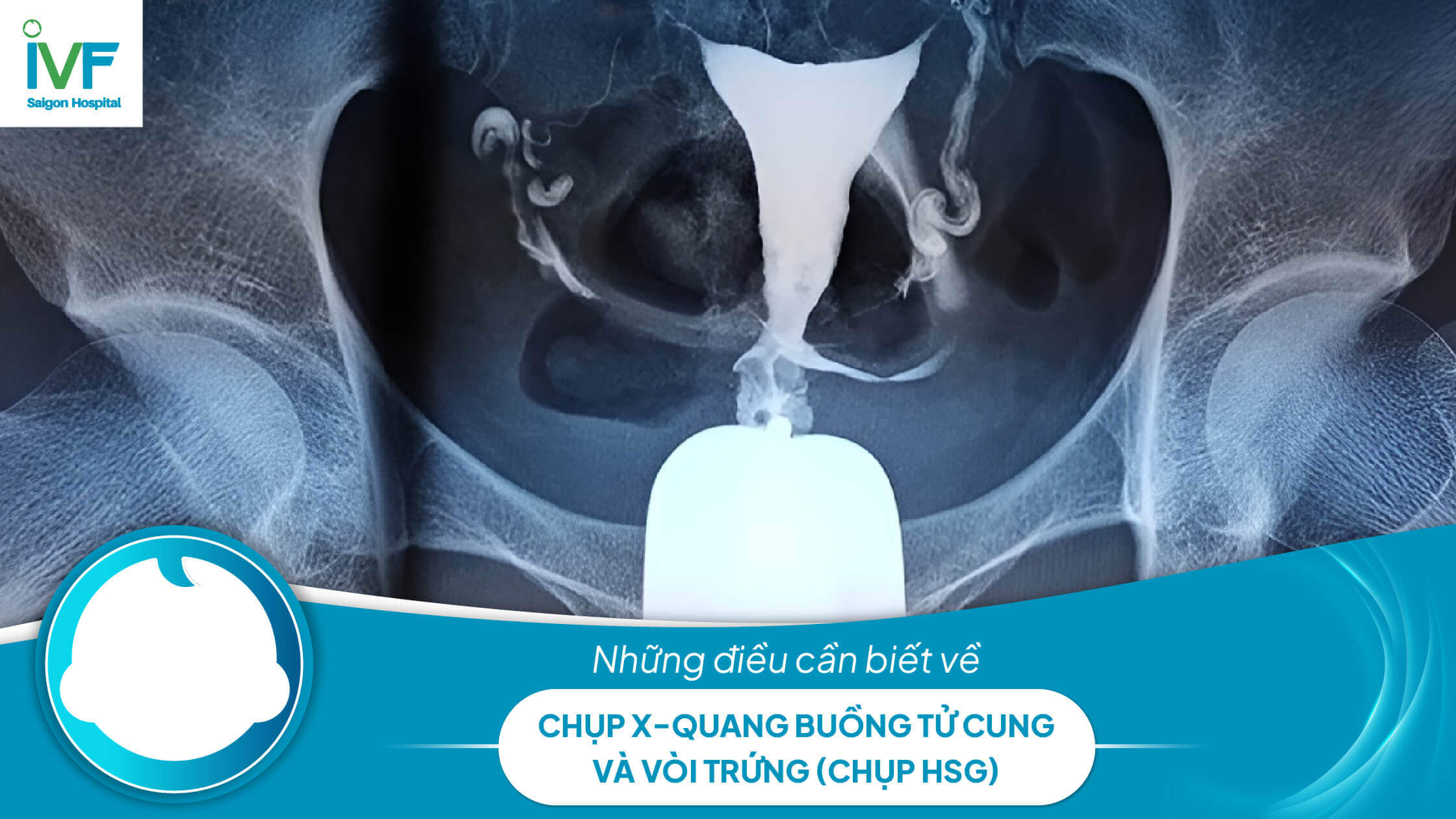 CHỤP X-QUANG VÒI TRỨNG (HSG) để làm gì?