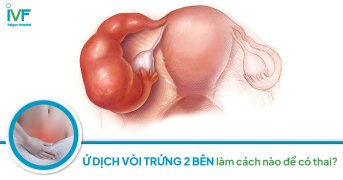 Ứ dịch vòi trứng 2 bên làm cách nào để có thai?