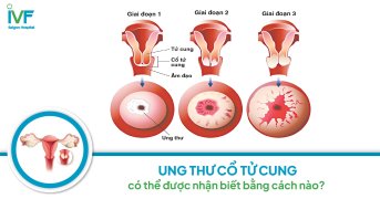 Ung thư cổ tử cung có thể nhận biết bằng cách nào?