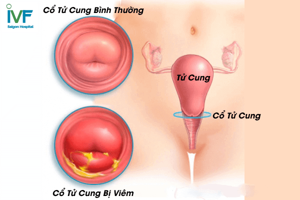 áp lạnh cổ tử cung