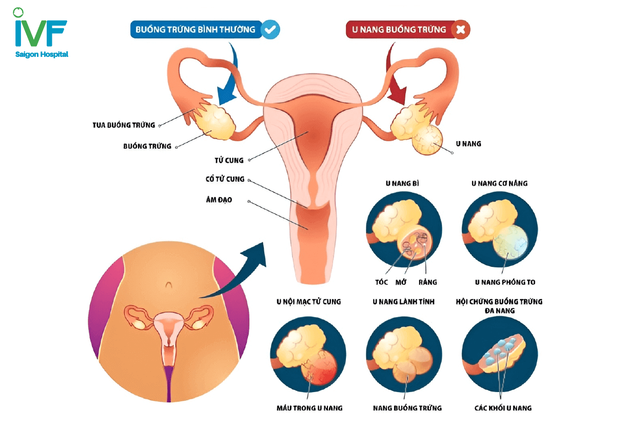 mổ u nang buồng trứng