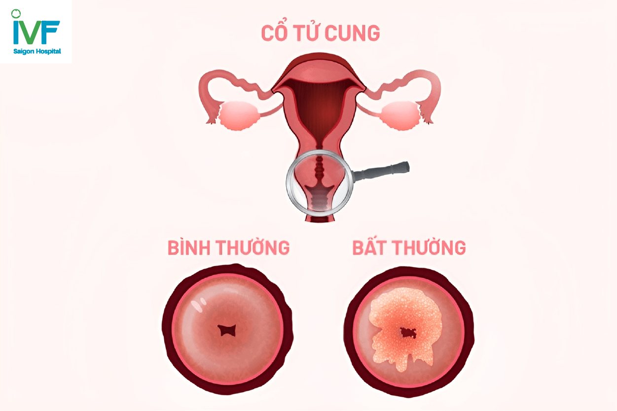 viêm lộ tuyến cổ tử cung