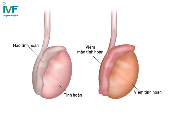 tinh hoàn có cục cứng