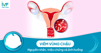 Viêm vùng chậu: Nguyên nhân, triệu chứng và ảnh hưởng