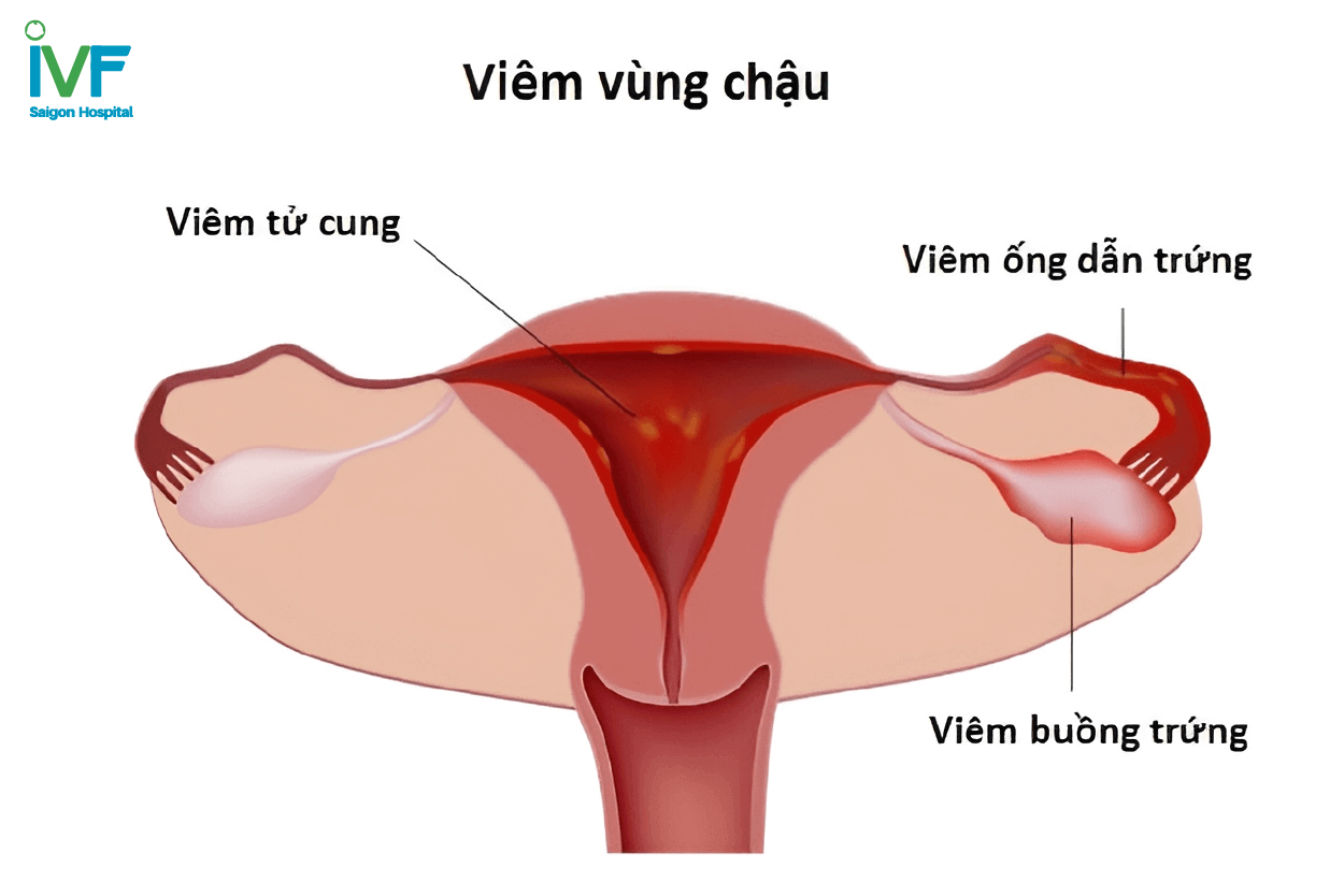 viêm vùng chậu