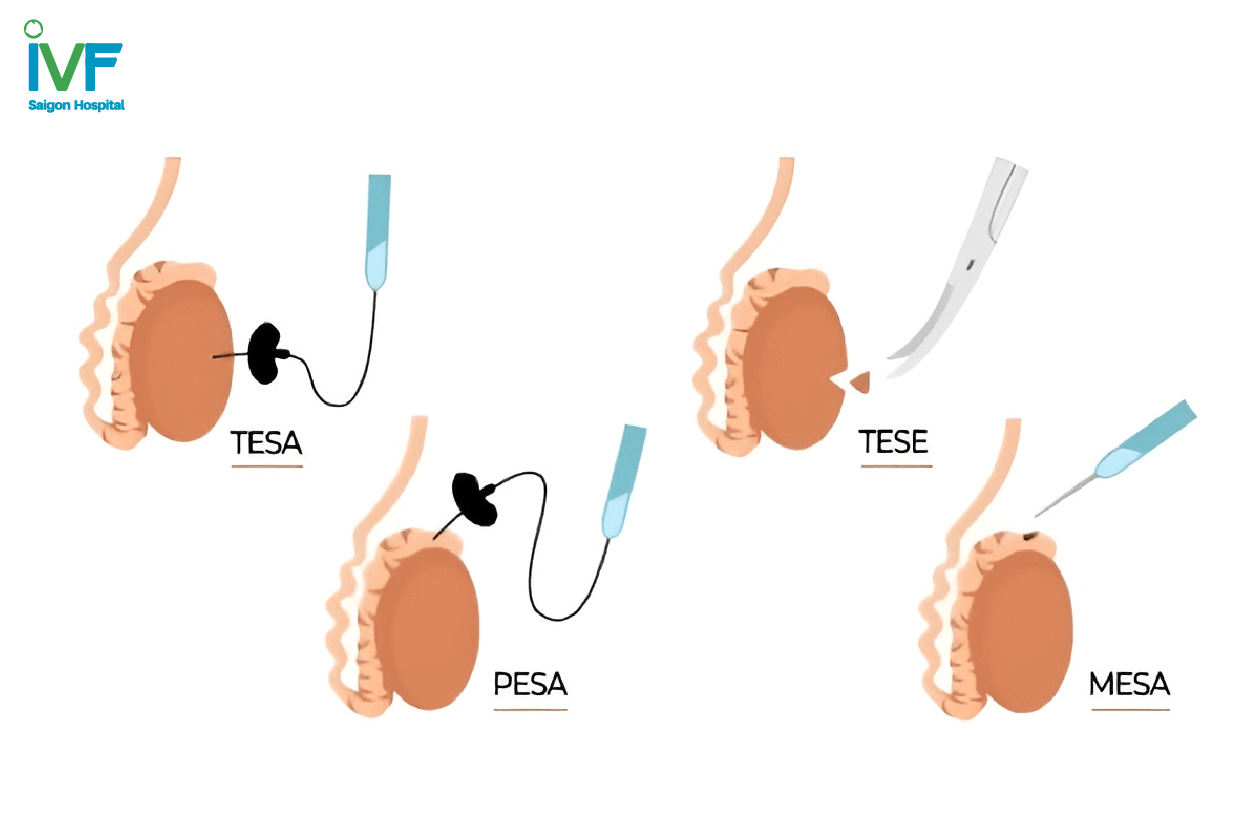 phẫu thuật lấy tinh trùng