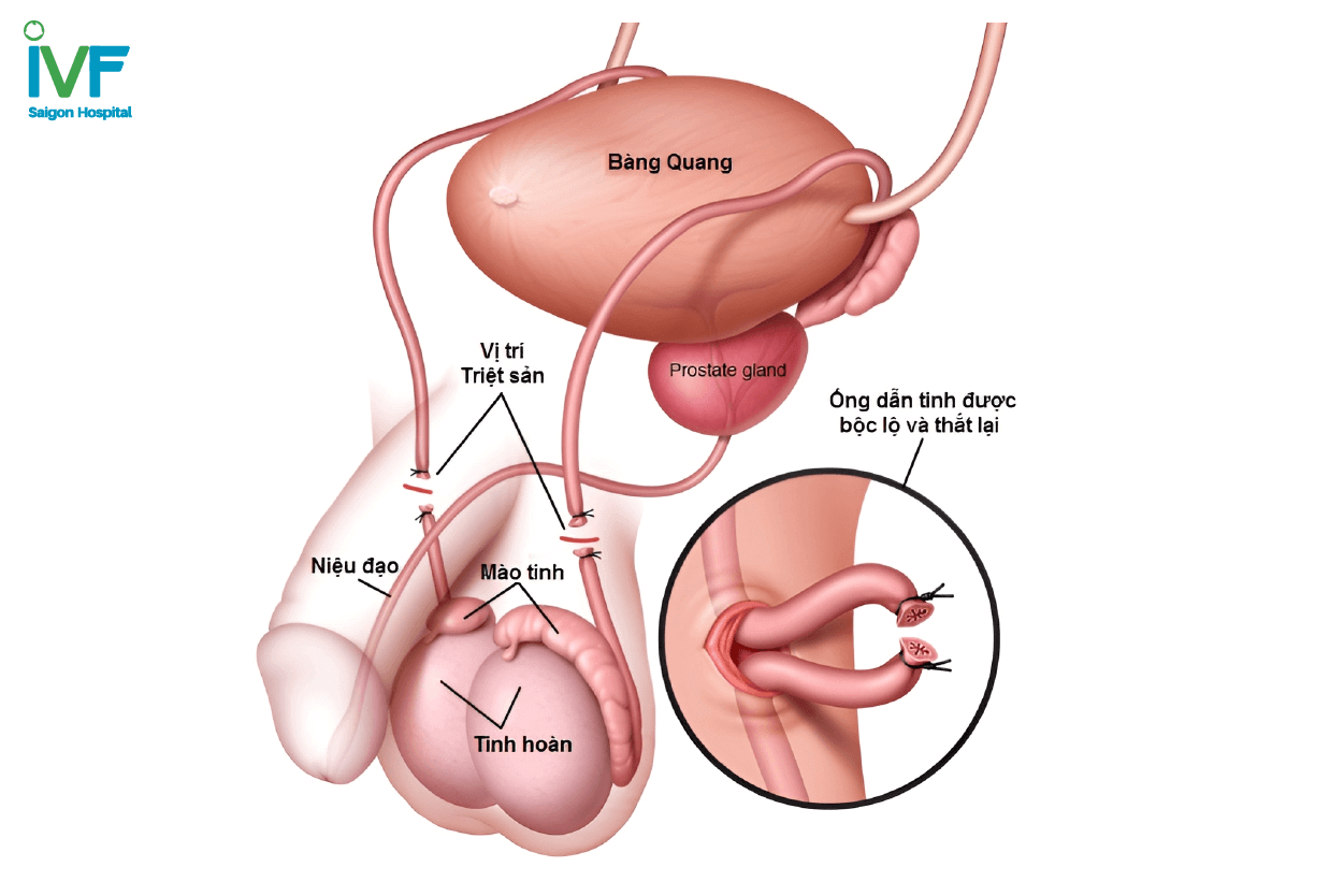 nối ống dẫn tinh