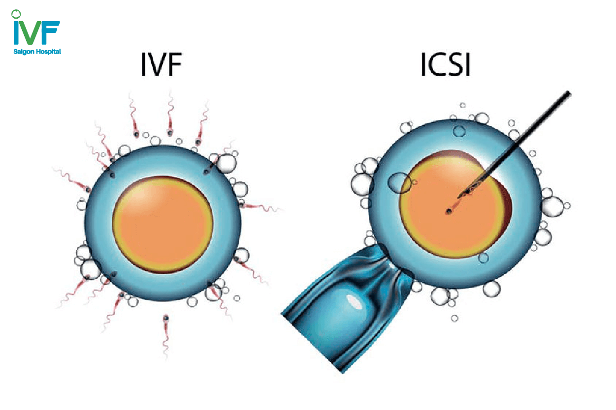 IVF và ICSI