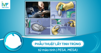 Phẫu thuật lấy tinh trùng từ mào tinh ( PESA, MESA)