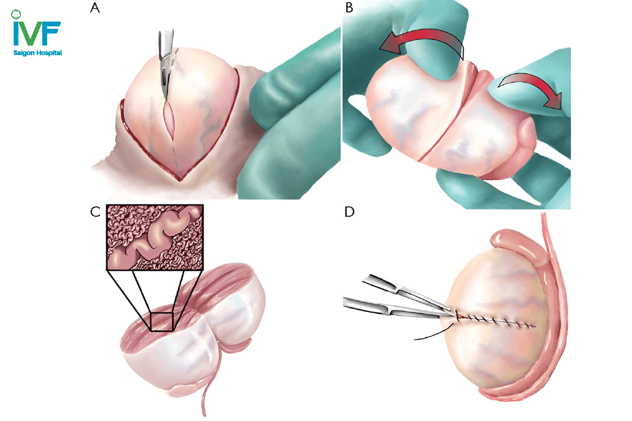 phẫu thuật lấy tinh trùng