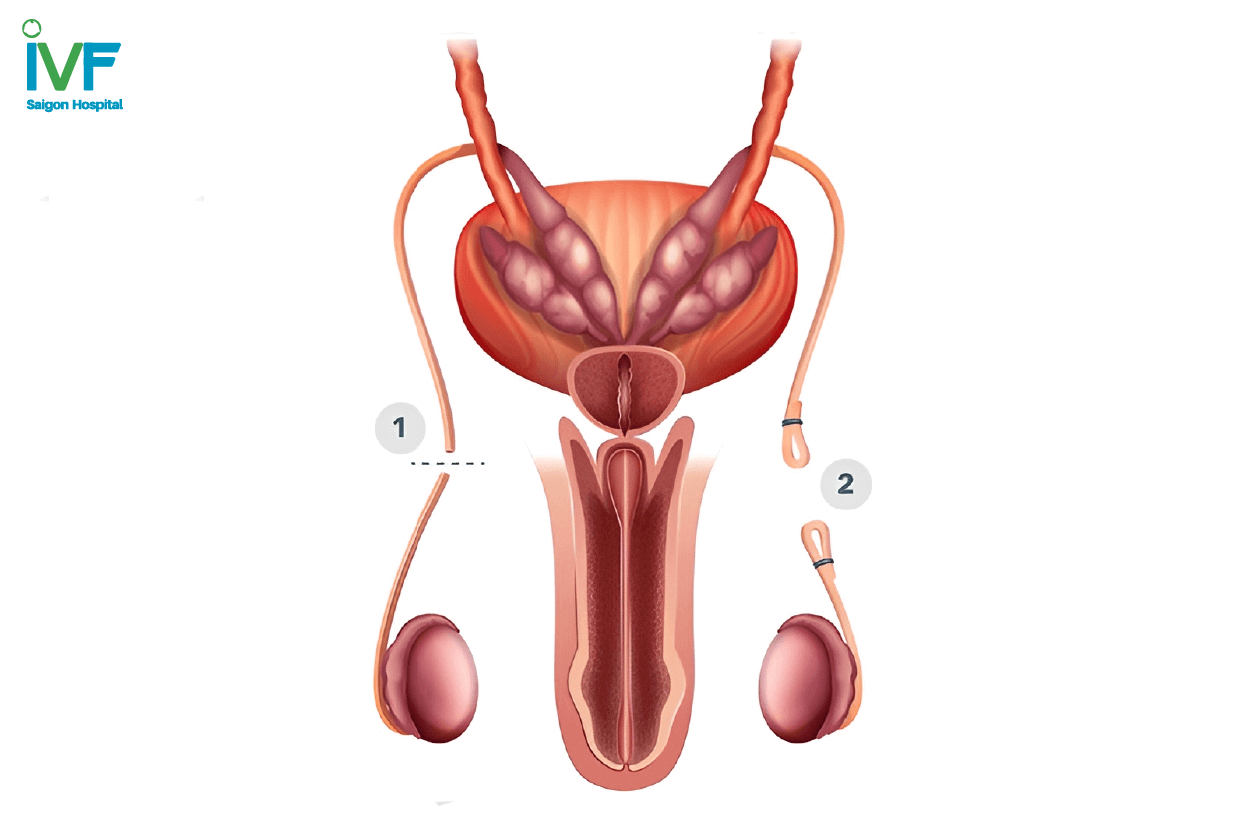 nối ống dẫn tinh