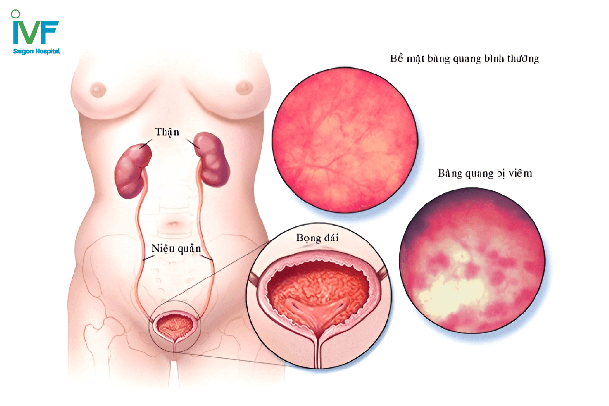 bàng quang chảy máu