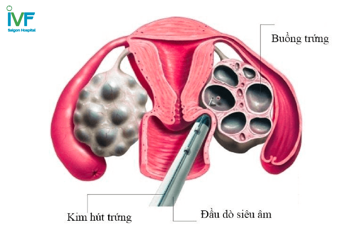 bàng quang chảy máu