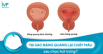 Bàng quang chảy máu sau chọc hút trứng là nguyên nhân gì?