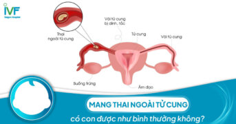 Mang thai ngoài tử cung có con được như bình thường không?