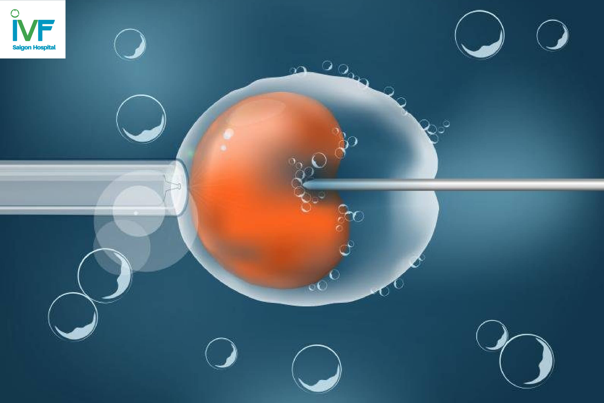 IVF và ICSI