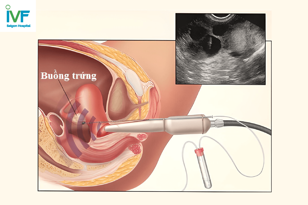 Quy trình sau chọc hút trứng