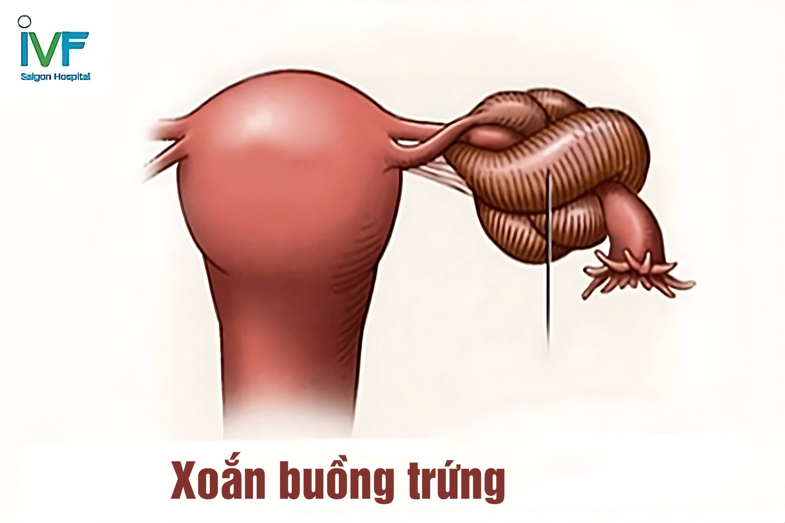 Xoắn buồng trứng 