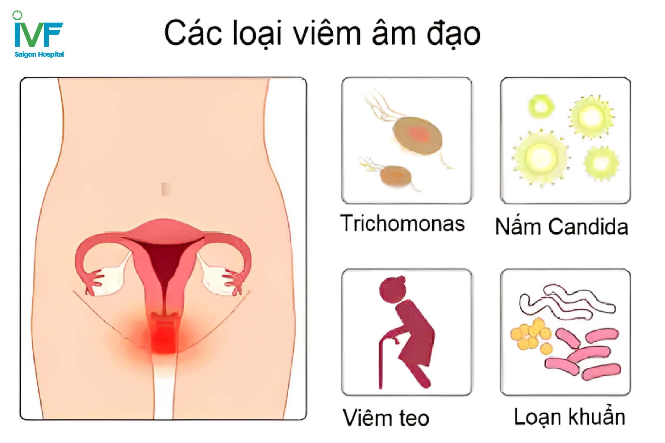 viêm âm đạo