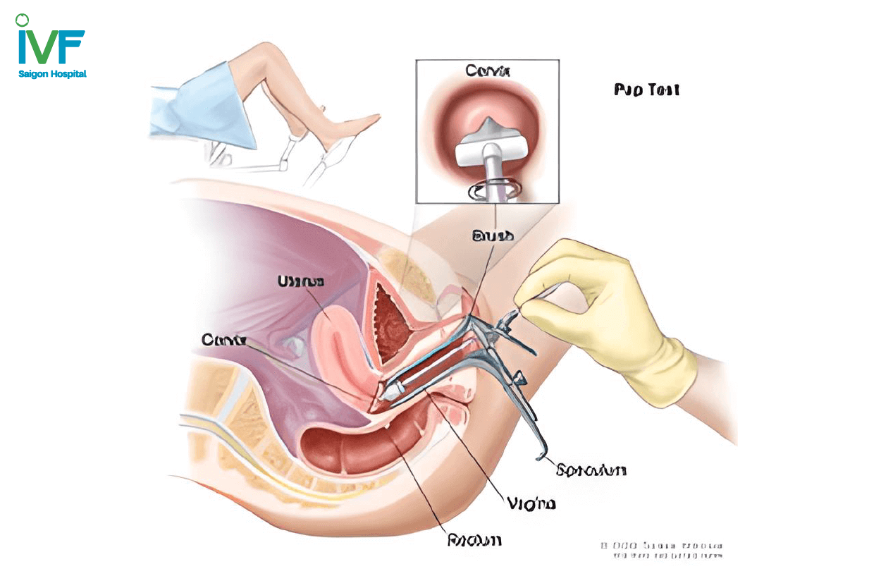 Ung thư cổ tử cung