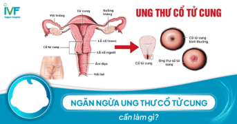 Ngăn ngừa ung thư cổ tử cung cần làm gì?